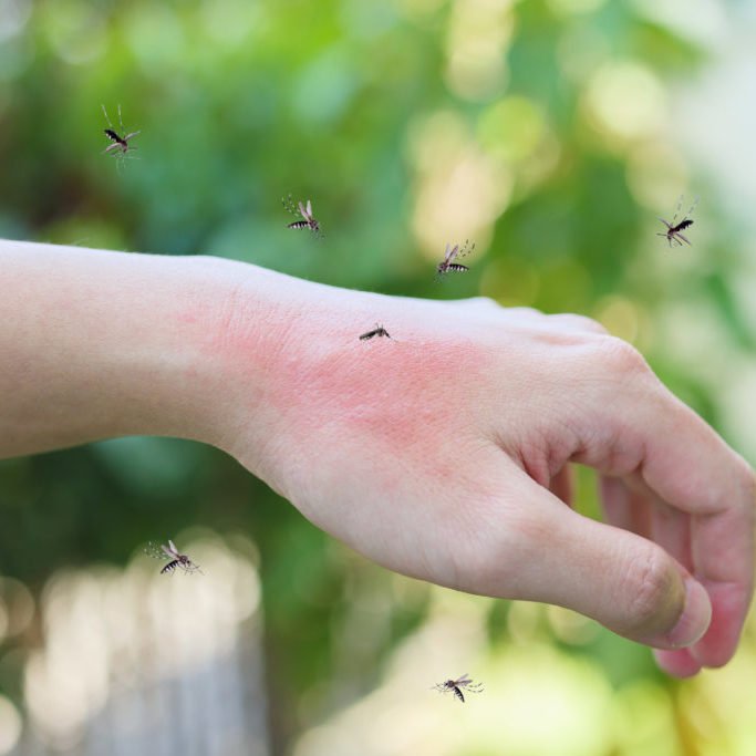 Mosquitoes bite on adult hand made skin rash and allergy with red spot